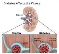 Diabetic Nephropathy Causes