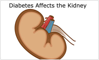 Diabetic Nephropathy Overview