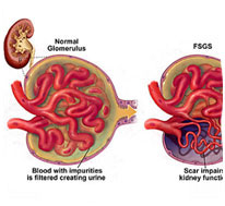 FSGS Diagnosis