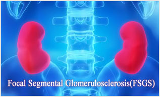 Overview Of FSGS