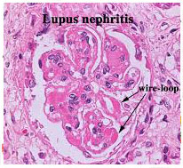 Lupus Nephritis Causes