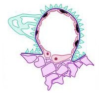 Lupus Nephritis Diagnosed