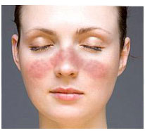 Lupus Nephritis Prognosis