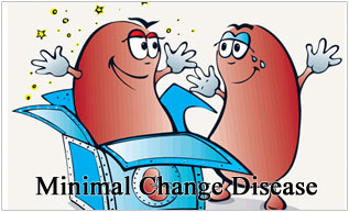 Overview Of Minimal Change Disease