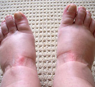 Nephrotic Syndrome Symptoms
