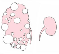 Polycystic Kidney Disease(PKD) Causes<
