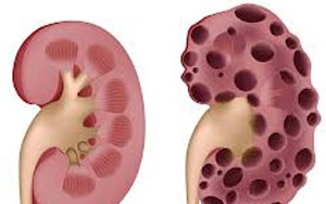 Overview Of Polycystic Kidney Disease(PKD)