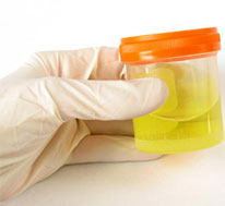 Purpura Nephritis Diagnosed