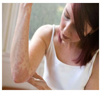 Purpura Nephritis Symptoms