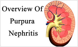 Overview Of Purpura Nephritis