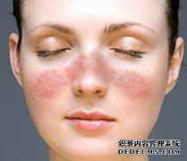 What Are the Symptoms of Lupus Nephritis