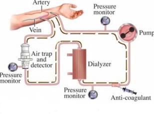 Dialysis For Kidney Failure