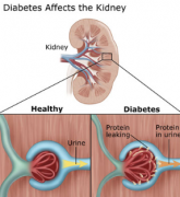 How Does Diabetes Cause Kidney Disease