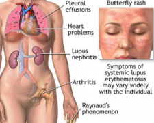 Is Lupus Deadly
