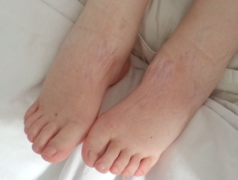 Lupus Nephritis: Say Goodbye to Severe Swelling