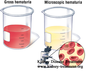 How Does IgA Nephropathy Cause Hematuria