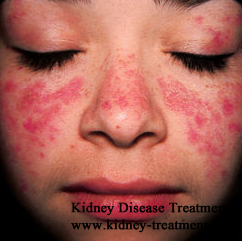 how to treat lupus kidney disease in China