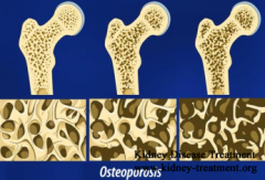 Causes for Renal Bone Disease