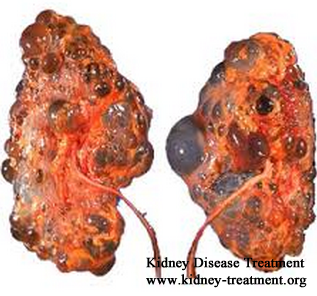 is there a cure for PKD
