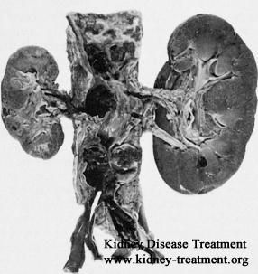 Is Kidney Atrophy Hereditary