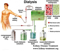 Type 2 Diabetes, Creatinine 13, BUN 119