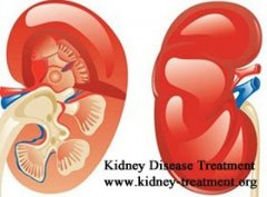 Best Way to Treat Polycystic Kidney Disease and ESRD Naturally