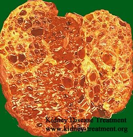8% Kidney Function in Polycystic Kidney Disease What does It Mean