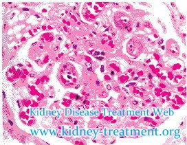 IgA Nephropathy with High Blood Pressure Can It be Cured