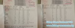 Good Treatment Help IgA Nephropathy Patient Reduce Her Creatinine Level to 298