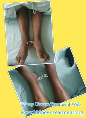 Edema of My Lower Extremities Disappeared Only after 15 Days Treatment