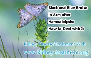 Black and Blue Bruise in Arm after Hemodialysis: How to Deal with It