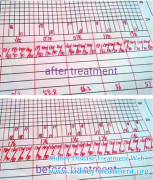 Diabetic Nephropathy with High Blood Pressure Also Can be Controlled Well