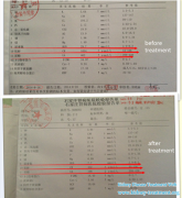 After Treatment Creatinine Level Decreased to 412 from 1054