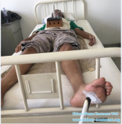 Swelling is Reduced in Shijiazhuang Kidney Disease Hospital