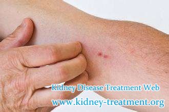 How to Alleviate Itching Skin for Diabetic Nephropathy Patients