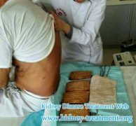 Can I Accept Micro-Chinese Medicine Osmotherapy in My Country