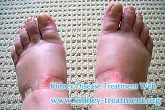 How to Dispel Edema For Diabetic Nephropathy Patients Naturally