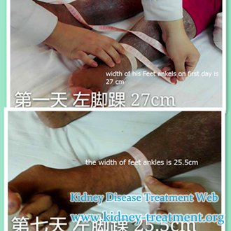 Can Edema be Resolved Aside from dialysis