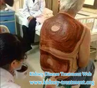 GFR 9% and Weakness, Is Dialysis Needed