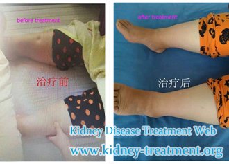 IgA Nephropathy and Creatinine 5.6, Can Edema be Cured Except Dialysis