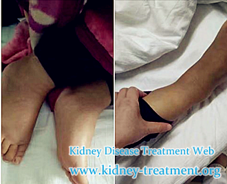 How to Dispel Edema in People with Chronic Nephritis