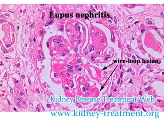 Is There Any Natural Treatment to Lupus Nephritis