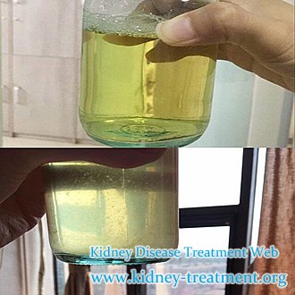 How to Treat Protein Urine for Nephrotic Syndrome Patients