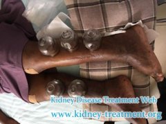 Creatinine 5.1 and Nausea, How to Treat Edema