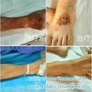 How to Treat Rash for Lupus Nephritis Patients with Creatinine 4.35