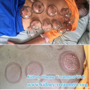 How to Get the Creatinine Level Down in Hypertensive Nephropathy