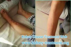 Creatinine 5.3 and Nephrotic Syndrome, How to Dispel Edema in Legs