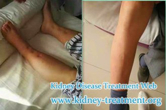 Creatinine 5.3 and Nephrotic Syndrome, How to Dispel Edema in Legs