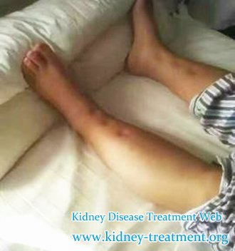 Creatinine 5.3 and Swelling, How to Deal With PKD