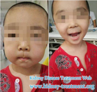 Is There Any Treatment For A 4 Years Girl with Nephrotic Syndrome